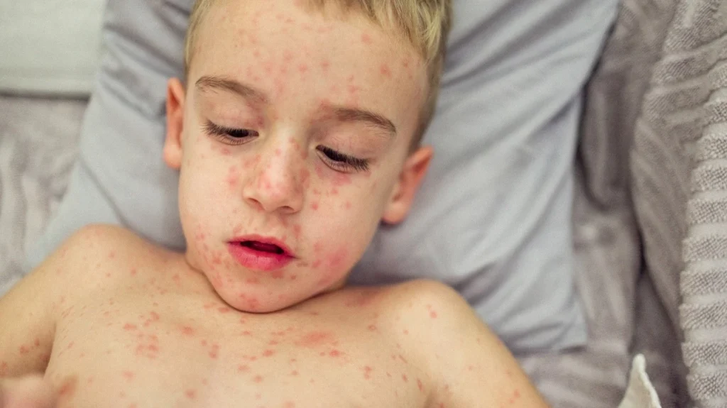 World Health Organization (WHO) released update on Measles